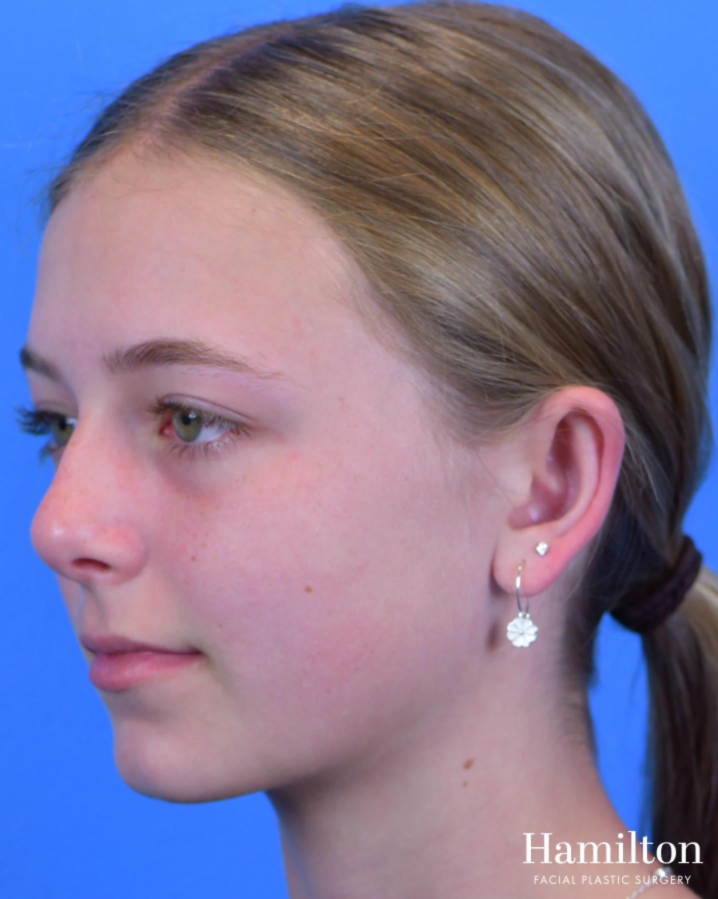 Otoplasty: Patient 2 - After 2