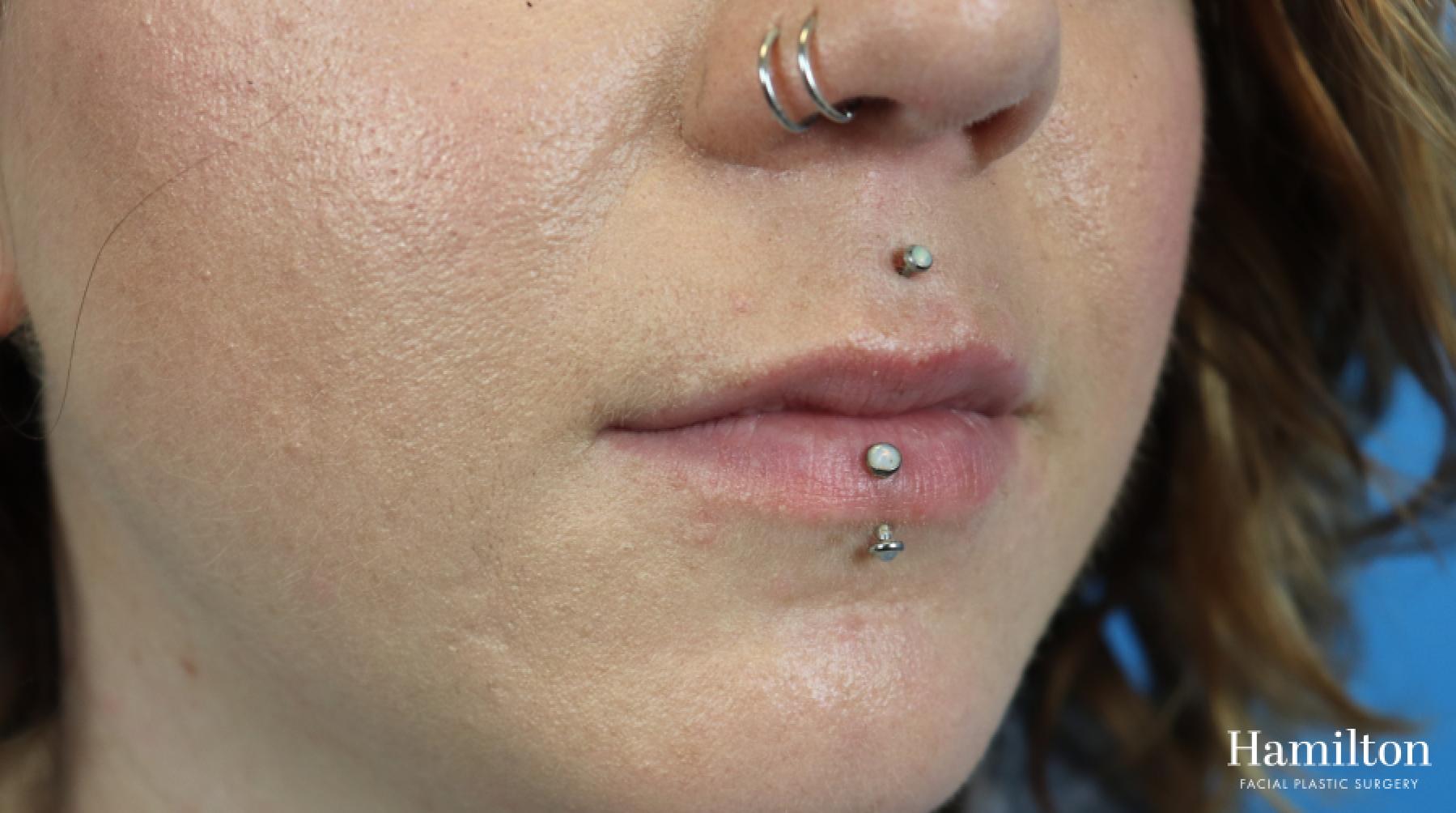 Fillers: Patient 7 - Before 2