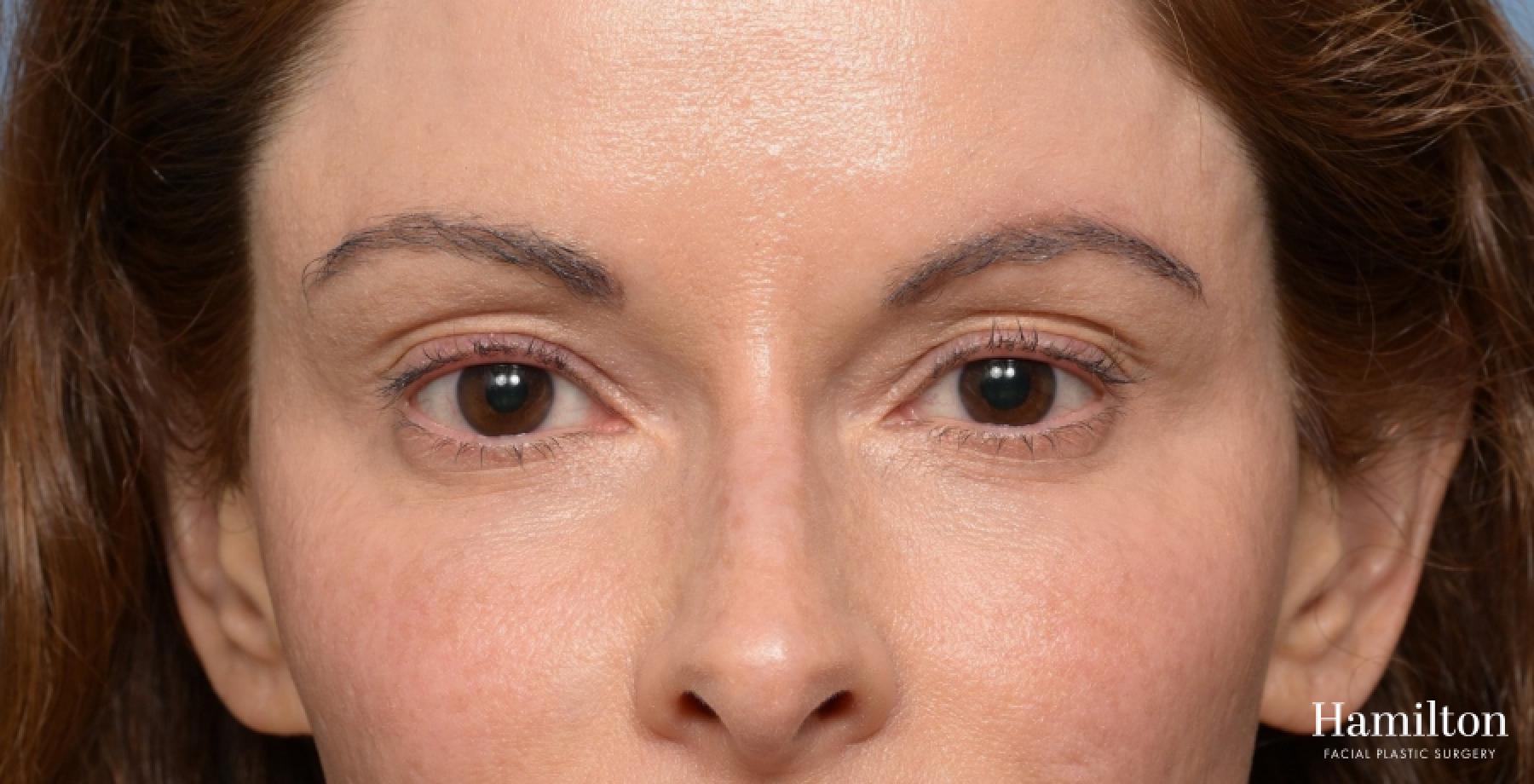 Blepharoplasty: Patient 6 - Before 4