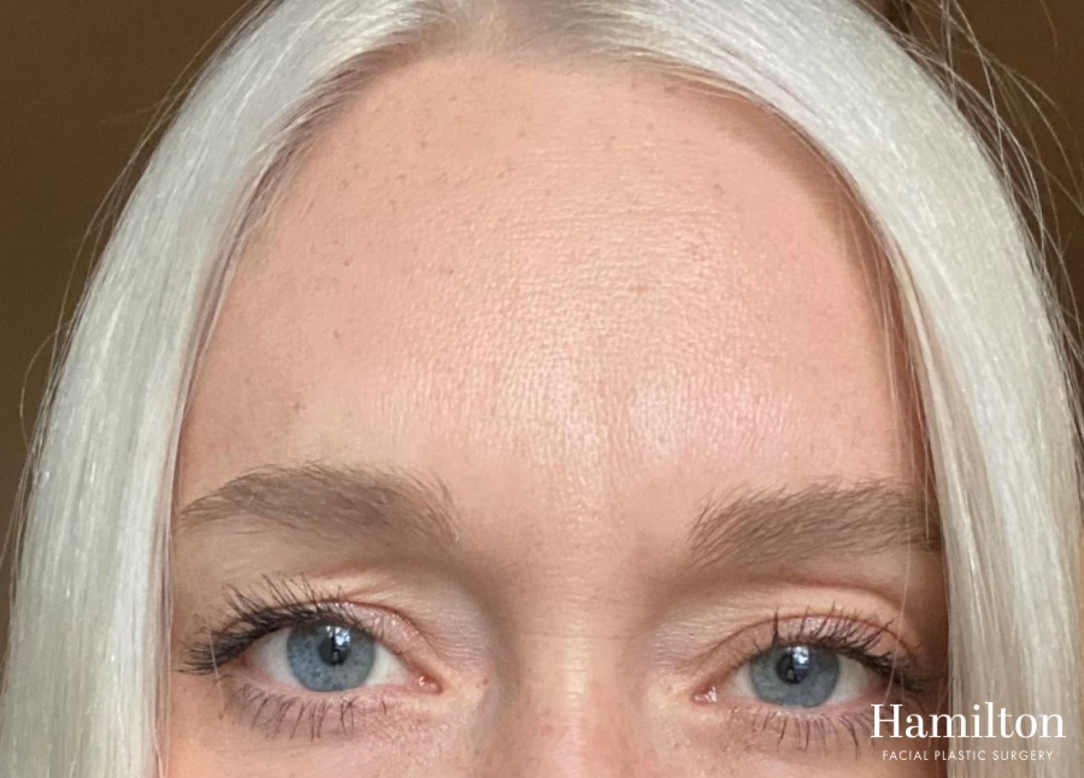 Neurotoxins/Botox: Patient 2 - After  