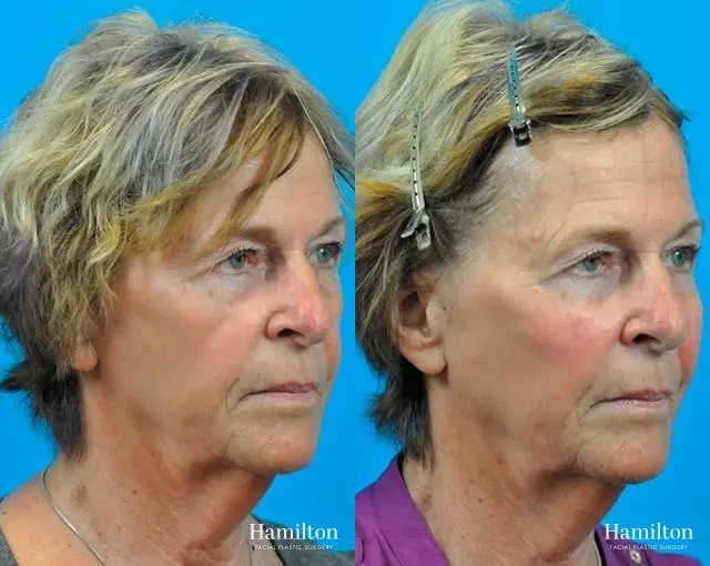 Voluma™ XC: Patient 1 - Before and After 3