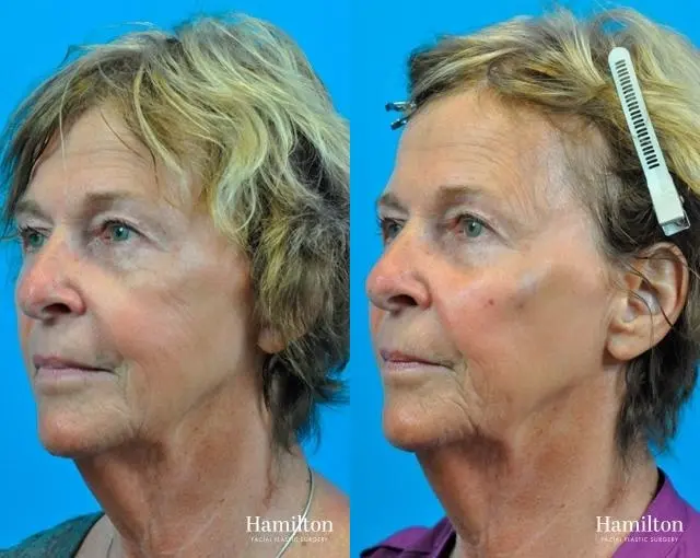 Voluma™ XC: Patient 1 - Before and After 2