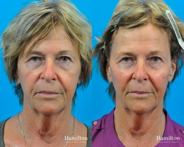 Voluma™ XC: Patient 1 - Before and After  