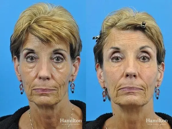 Voluma™ XC: Patient 2 - Before and After 1