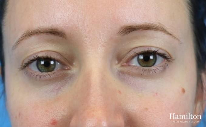 Fillers: Patient 6 - After  