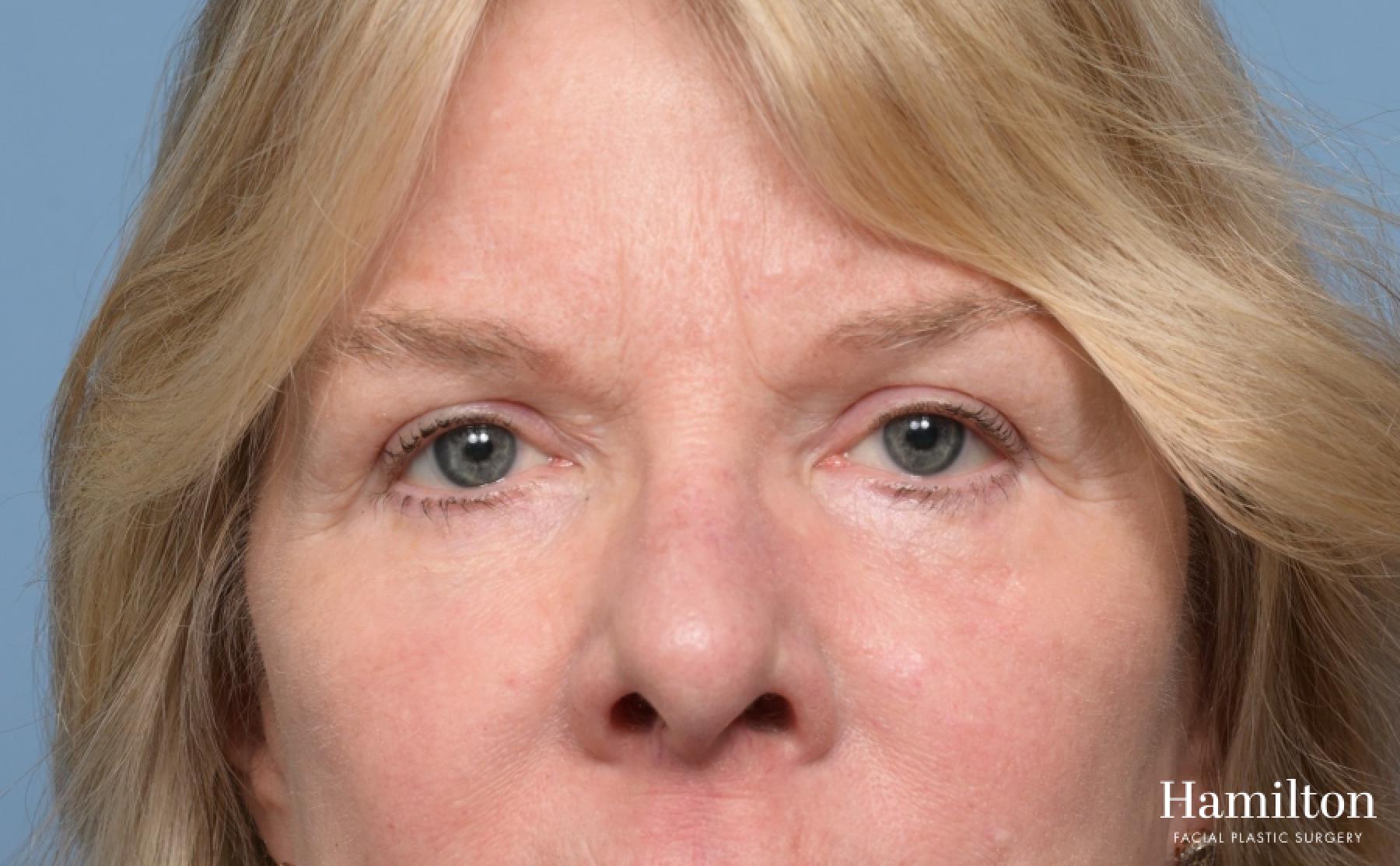 Blepharoplasty: Patient 11 - After 4