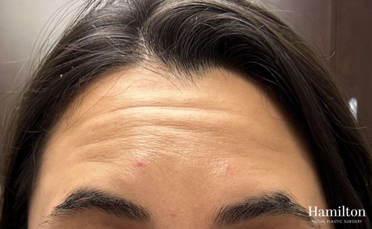 Neurotoxins/Botox: Patient 10 - Before 