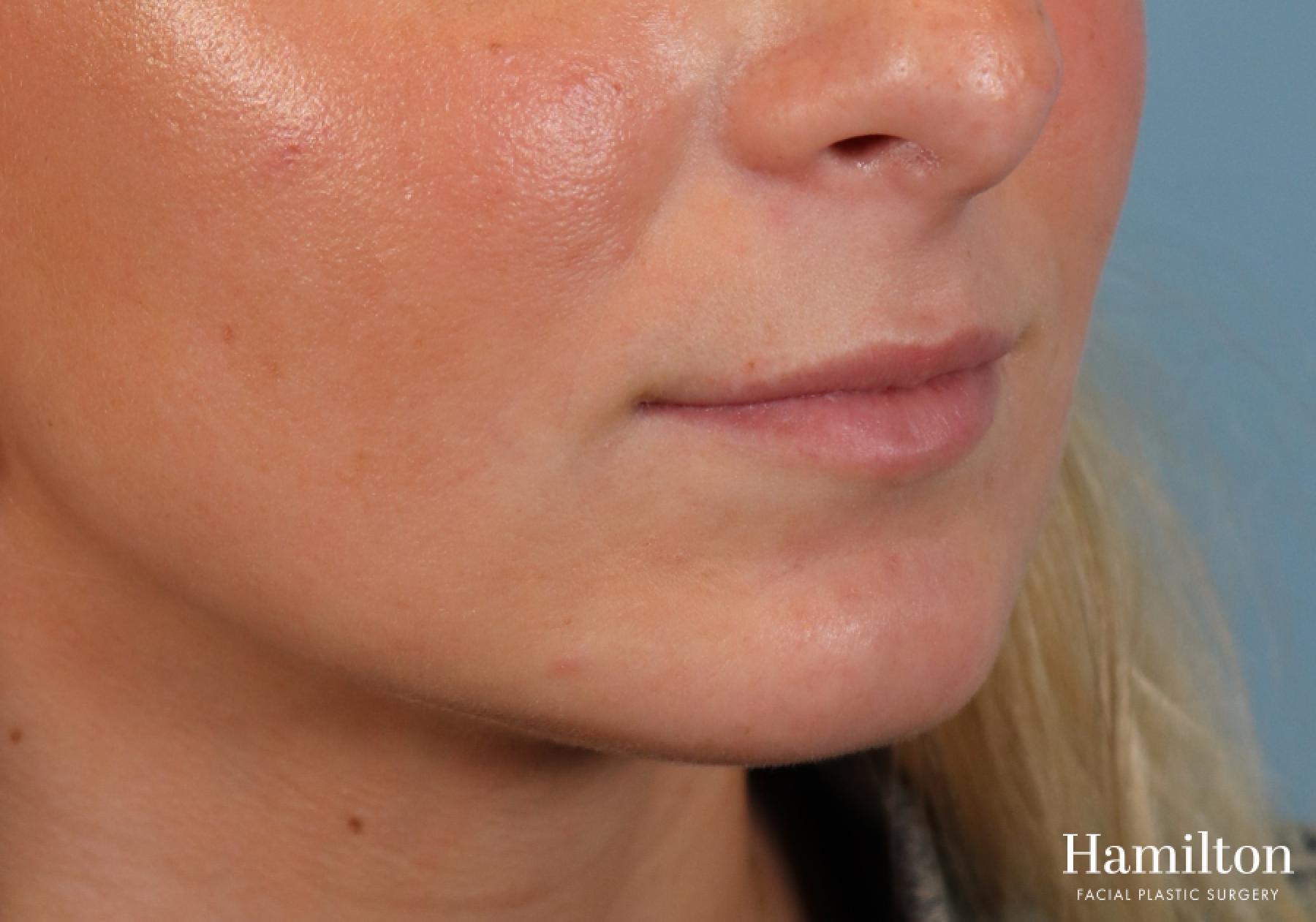 Fillers: Patient 9 - Before 