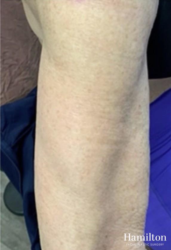 Broad Band Light (BBL): Patient 7 - After  