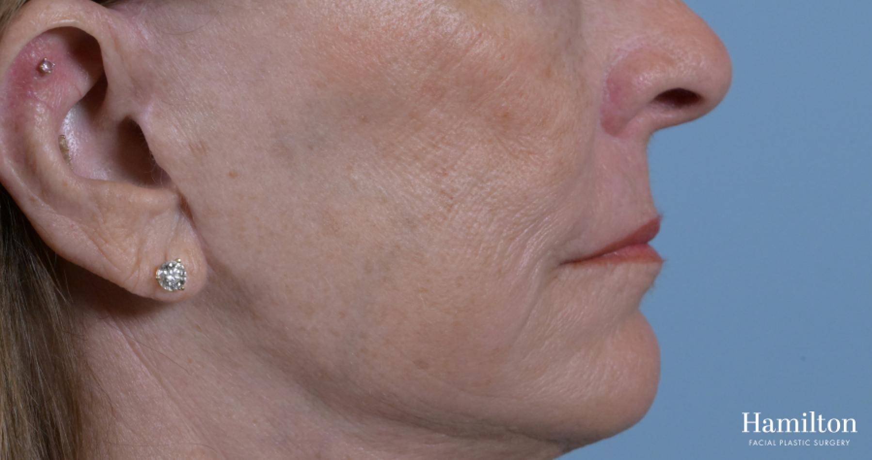 Sciton Laser: Patient 2 - After 6