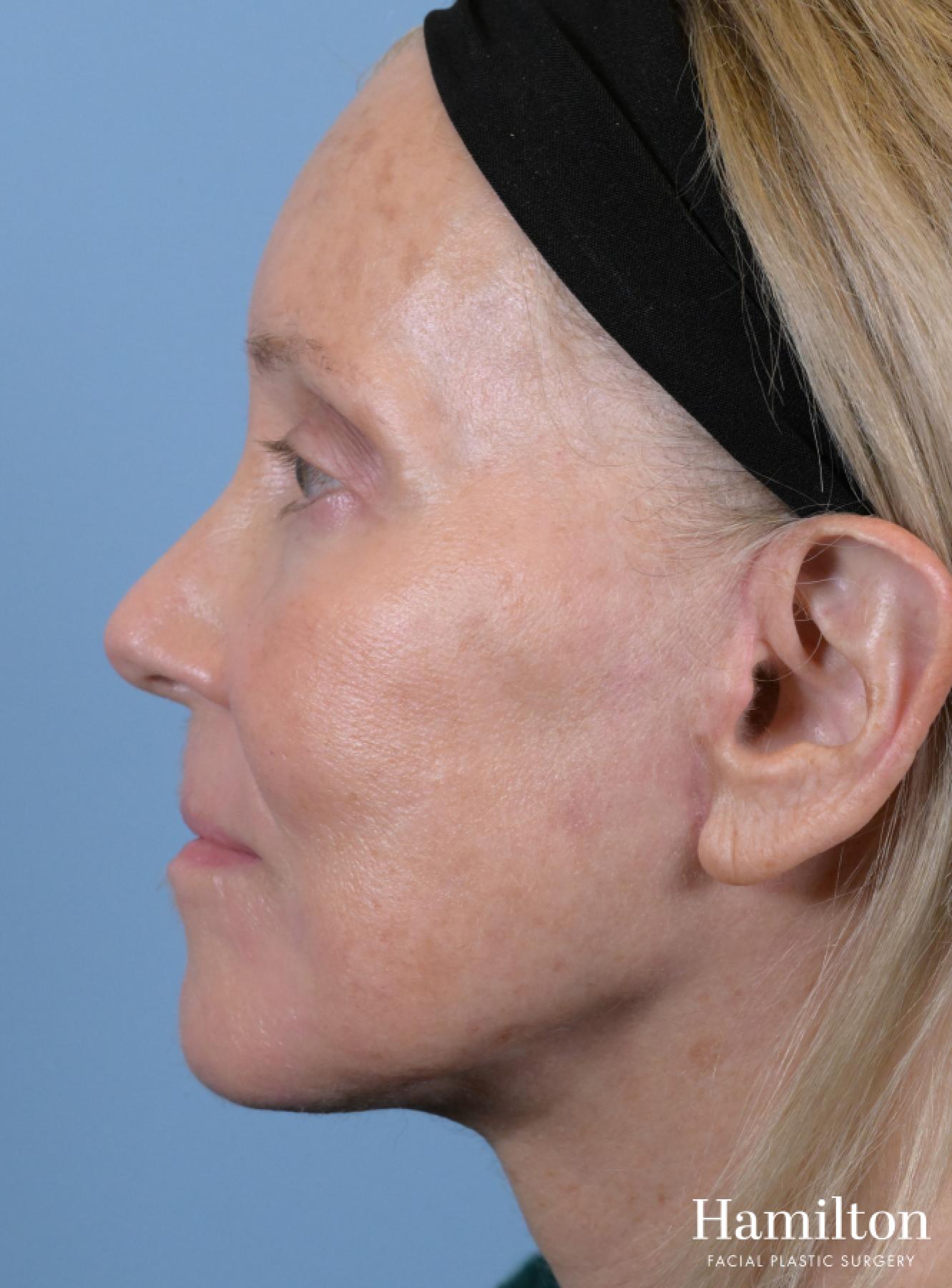 Facelift: Patient 3 - After 3