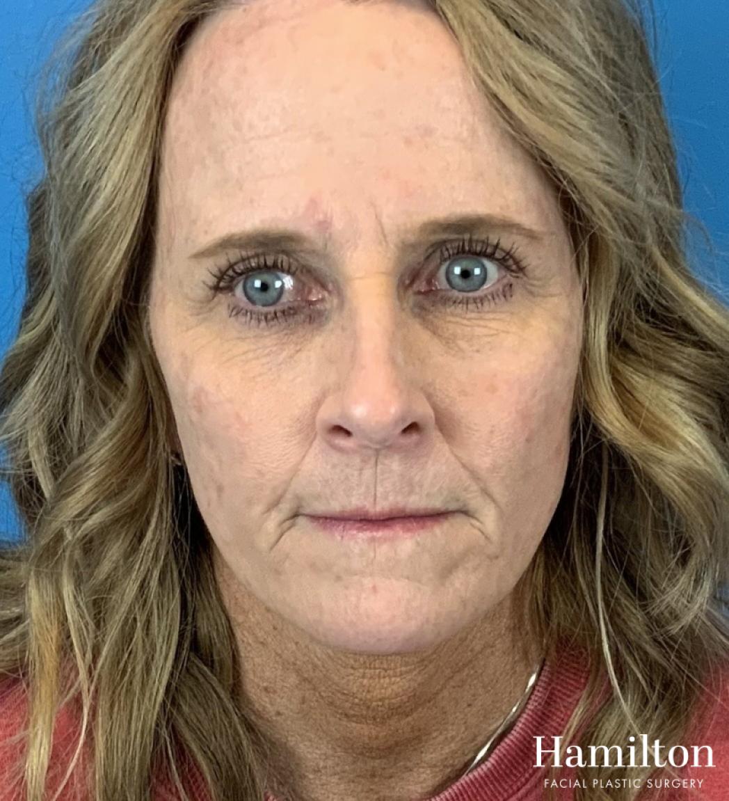 HALO Laser: Patient 3 - After 2