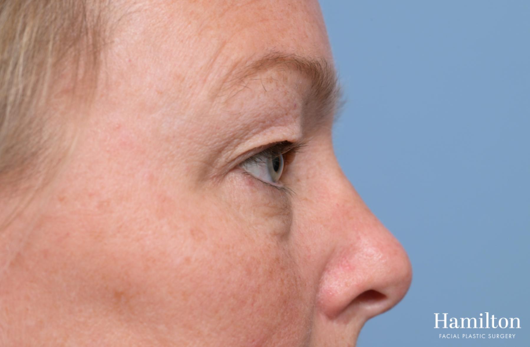 Blepharoplasty: Patient 2 - Before 6