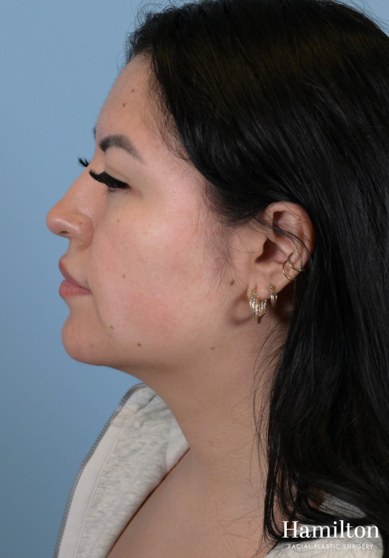 Buccal Fat Removal: Patient 1 - After 4