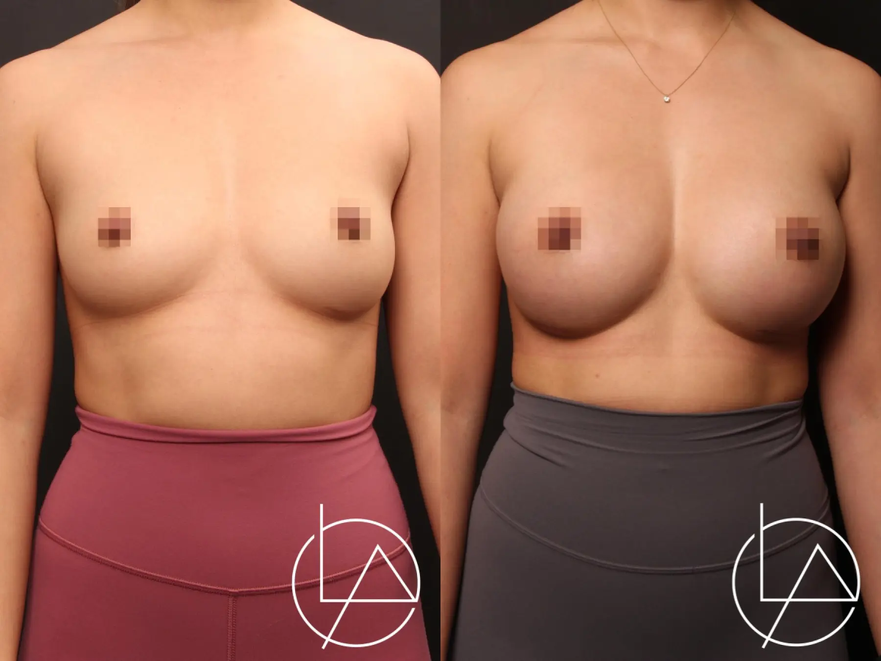 Breast Augmentation: Patient 1 - Before and After  