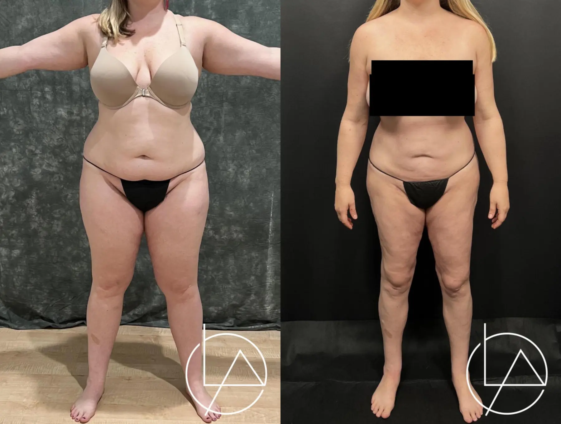 Lipedema Surgery: Patient 6 - Before and After  