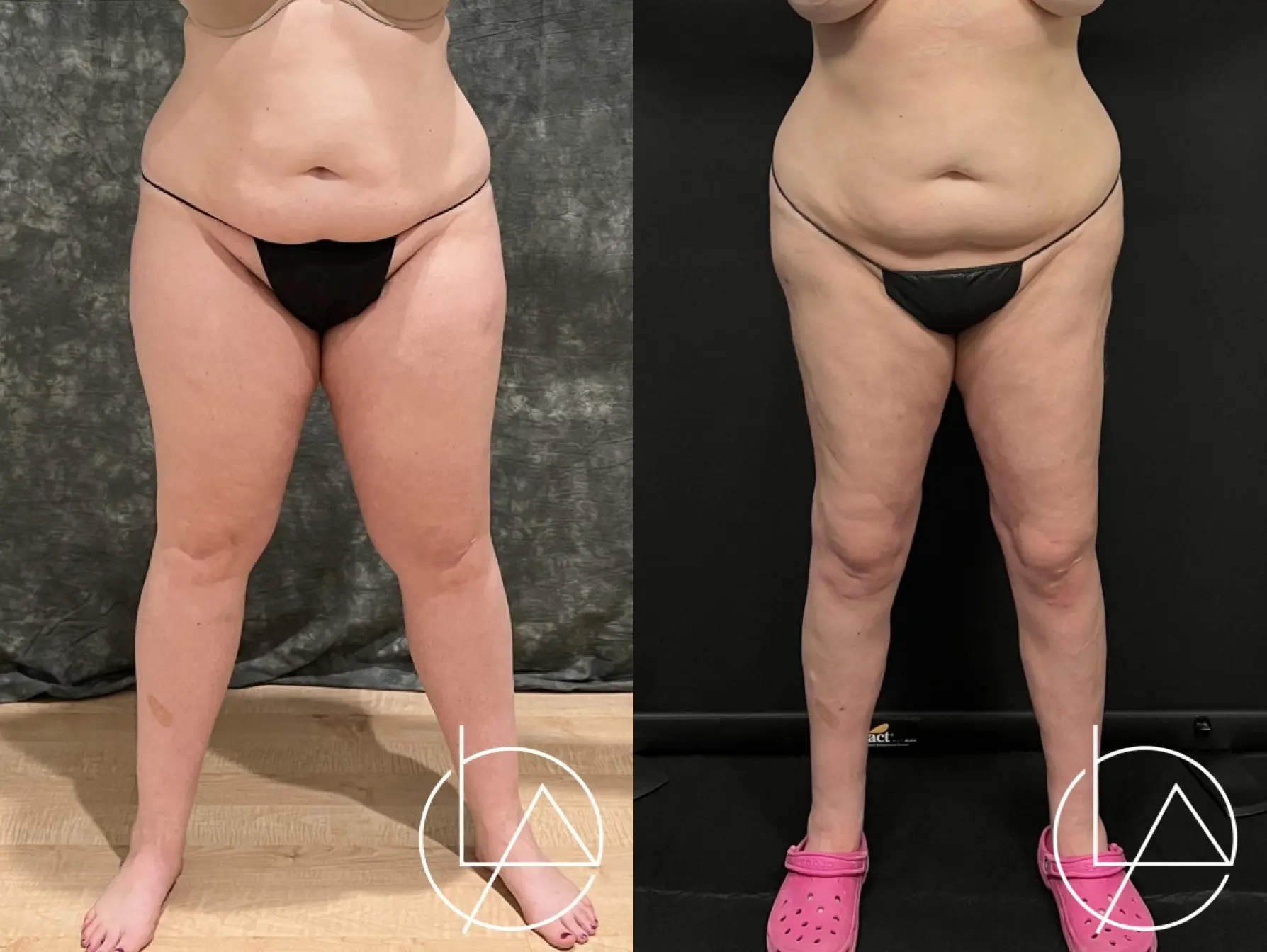 Lipedema Surgery: Patient 10 - Before and After  
