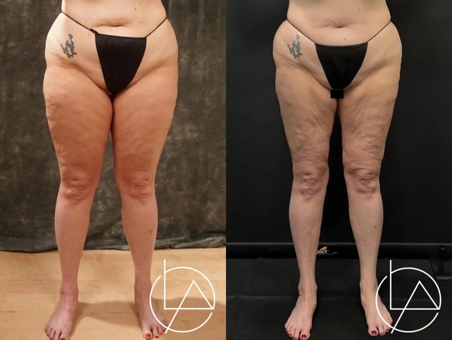 Lipedema Surgery: Patient 9 - Before and After  