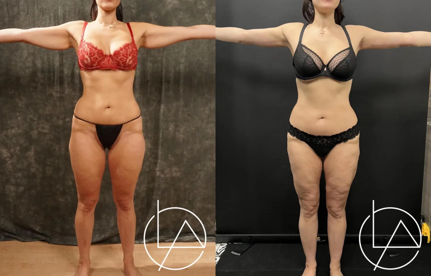 Lipedema Surgery Before & After Gallery