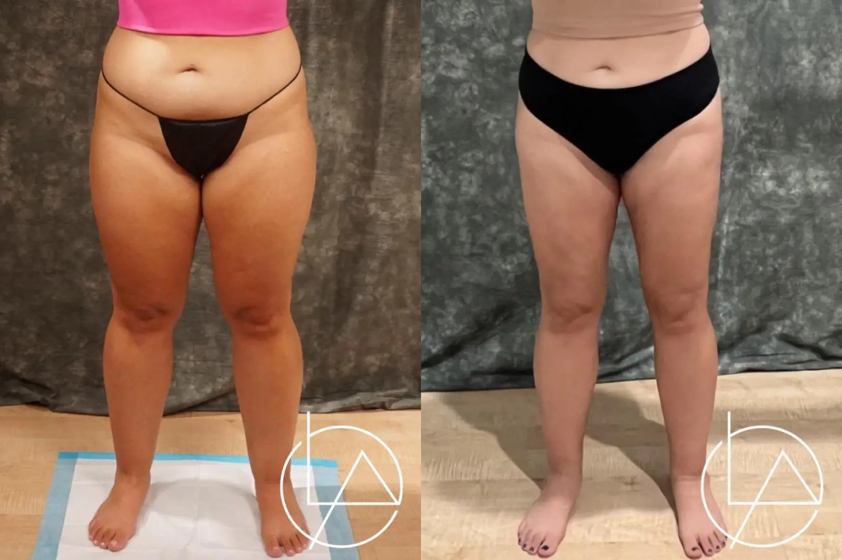 Lipedema Surgery: Patient 8 - Before and After  