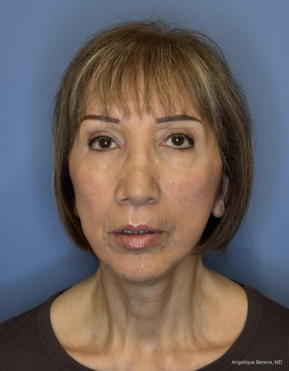 Facelift & Neck Lift: Patient 10 - After  