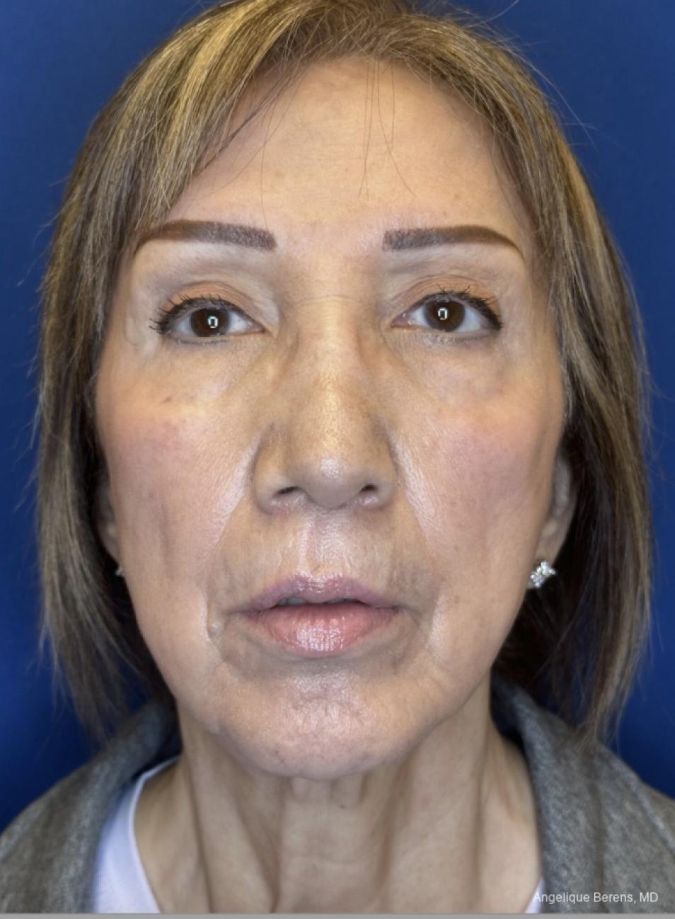Facelift & Neck Lift: Patient 10 - After  
