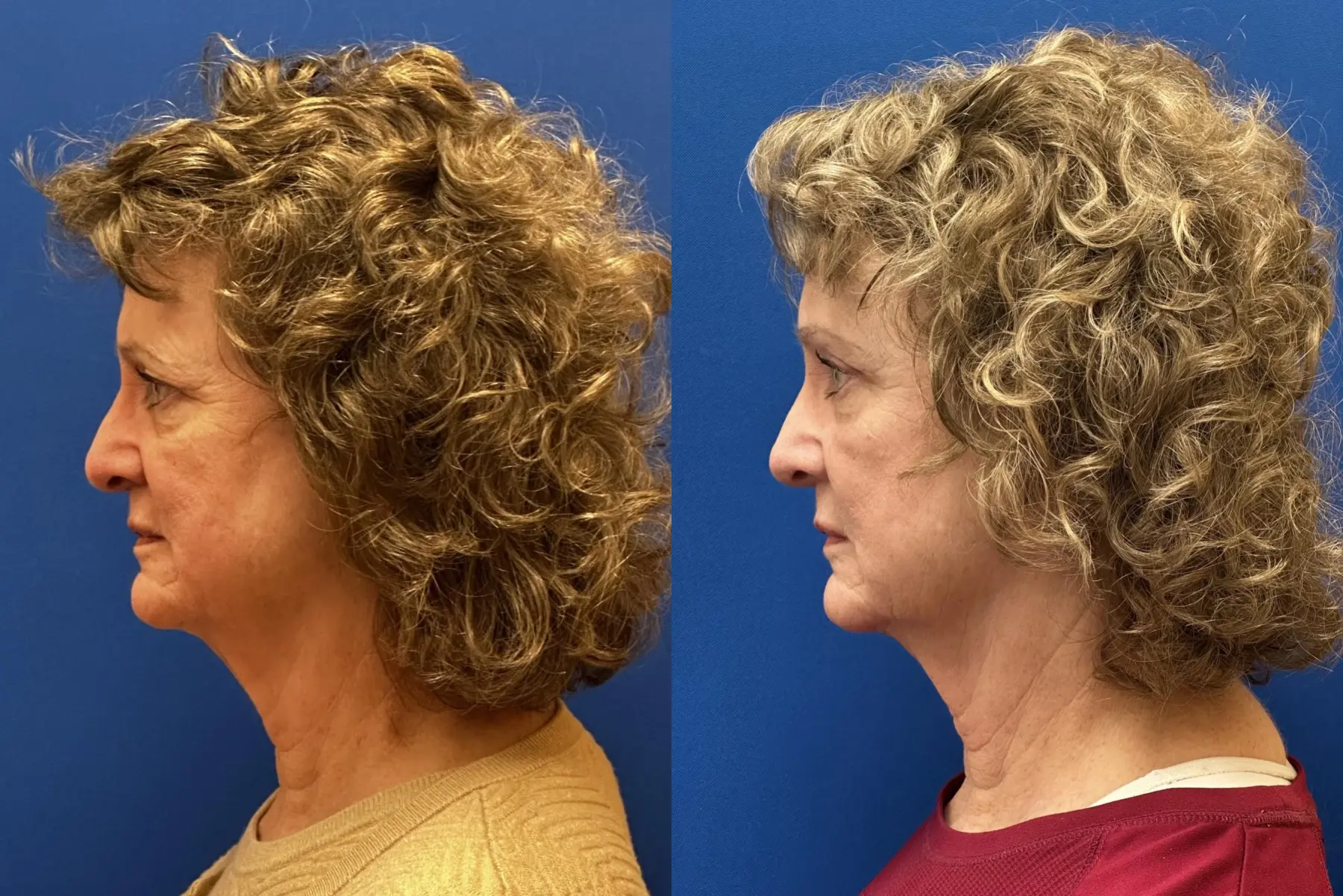 Brow Lift: Patient 2 - Before and After  