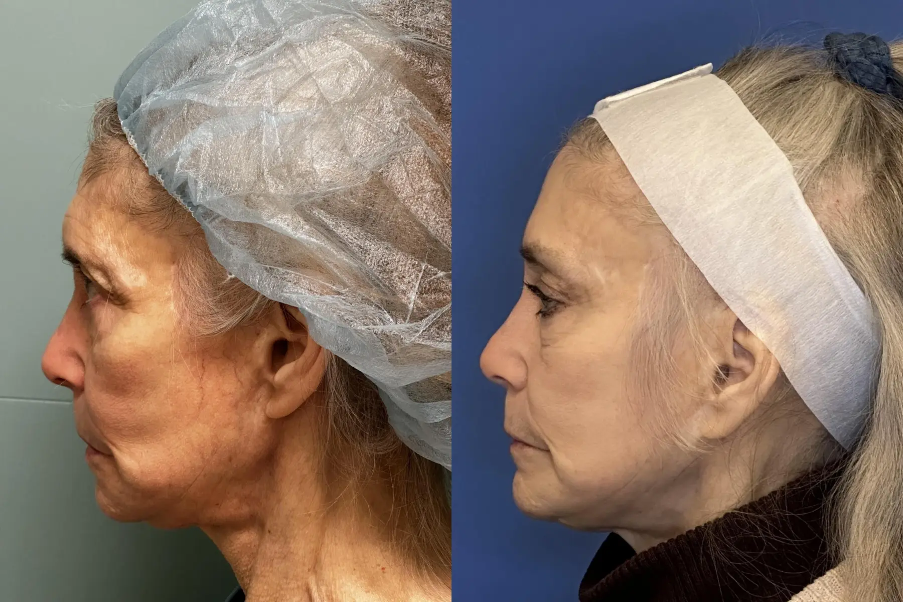 Brow Lift: Patient 1 - Before and After  