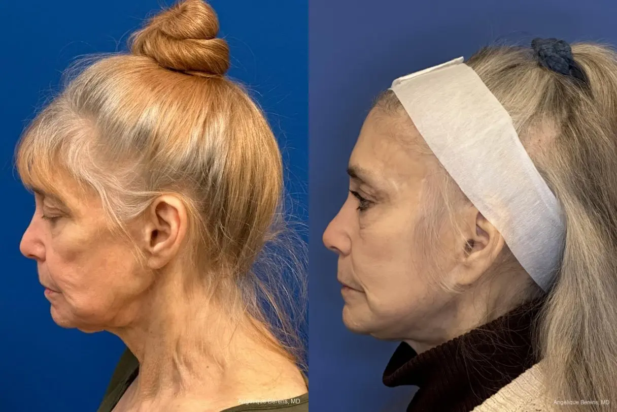 Facelift & Neck Lift: Patient 9 - Before and After  