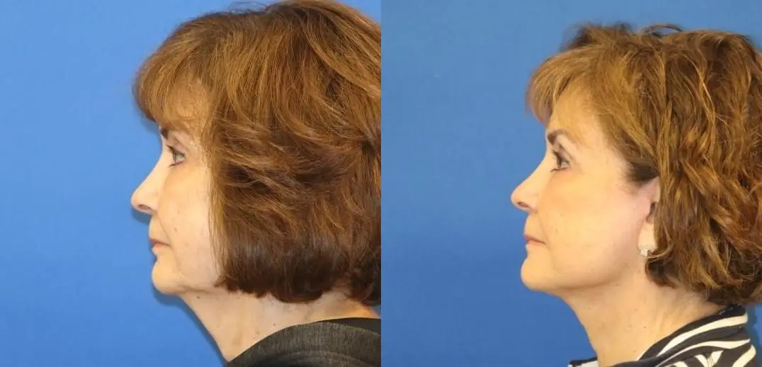 Facelift & Neck Lift: Patient 6 - Before and After  