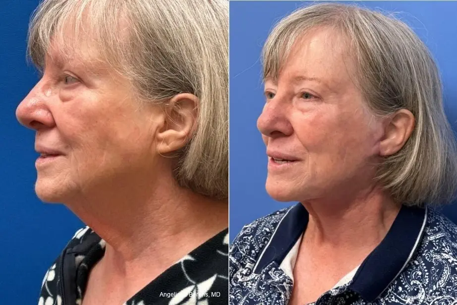 Facelift & Neck Lift: Patient 5 - Before and After  