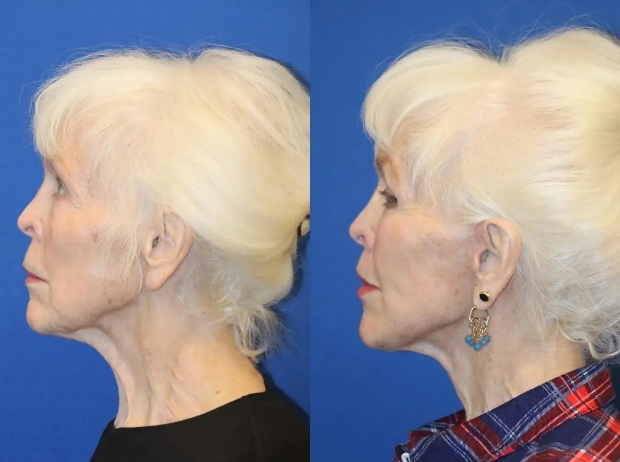 Facelift & Neck Lift: Patient 2 - Before and After  