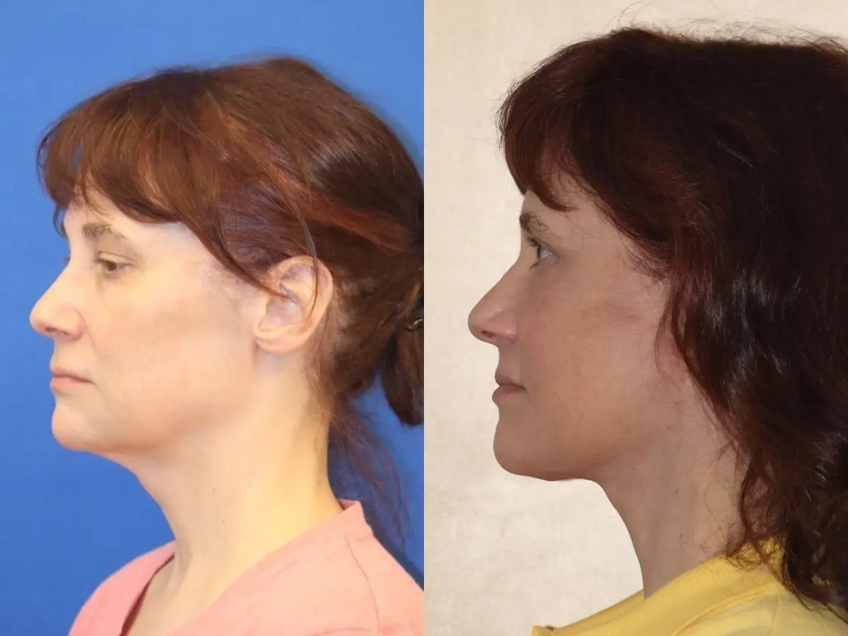 Facelift & Neck Lift: Patient 3 - Before and After  