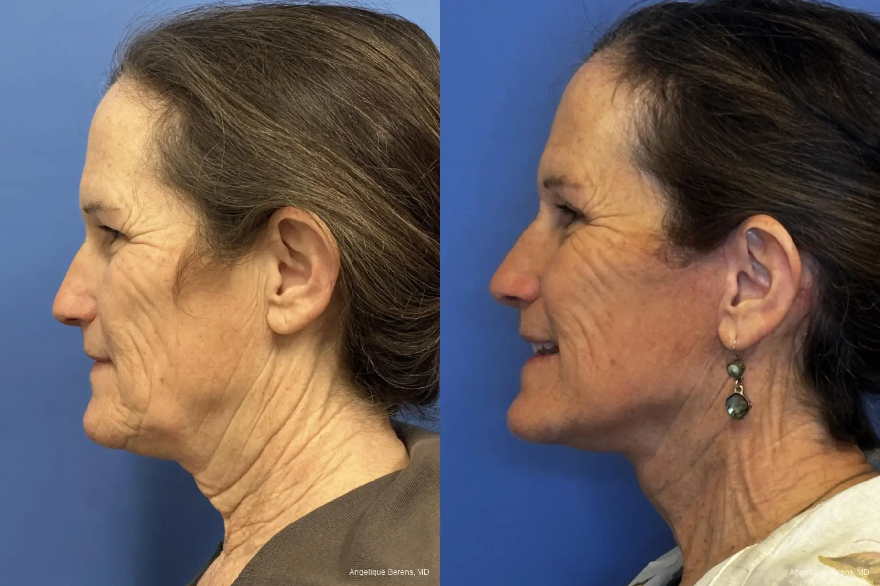 Facelift & Neck Lift: Patient 8 - Before and After  