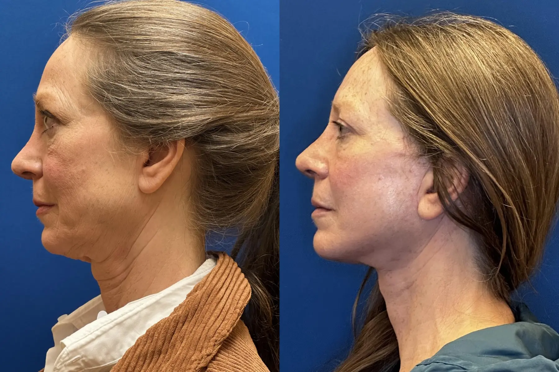 Facelift & Neck Lift: Patient 7 - Before and After  