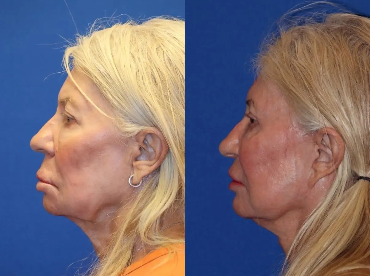 Facelift & Neck Lift: Patient 1 - Before and After  