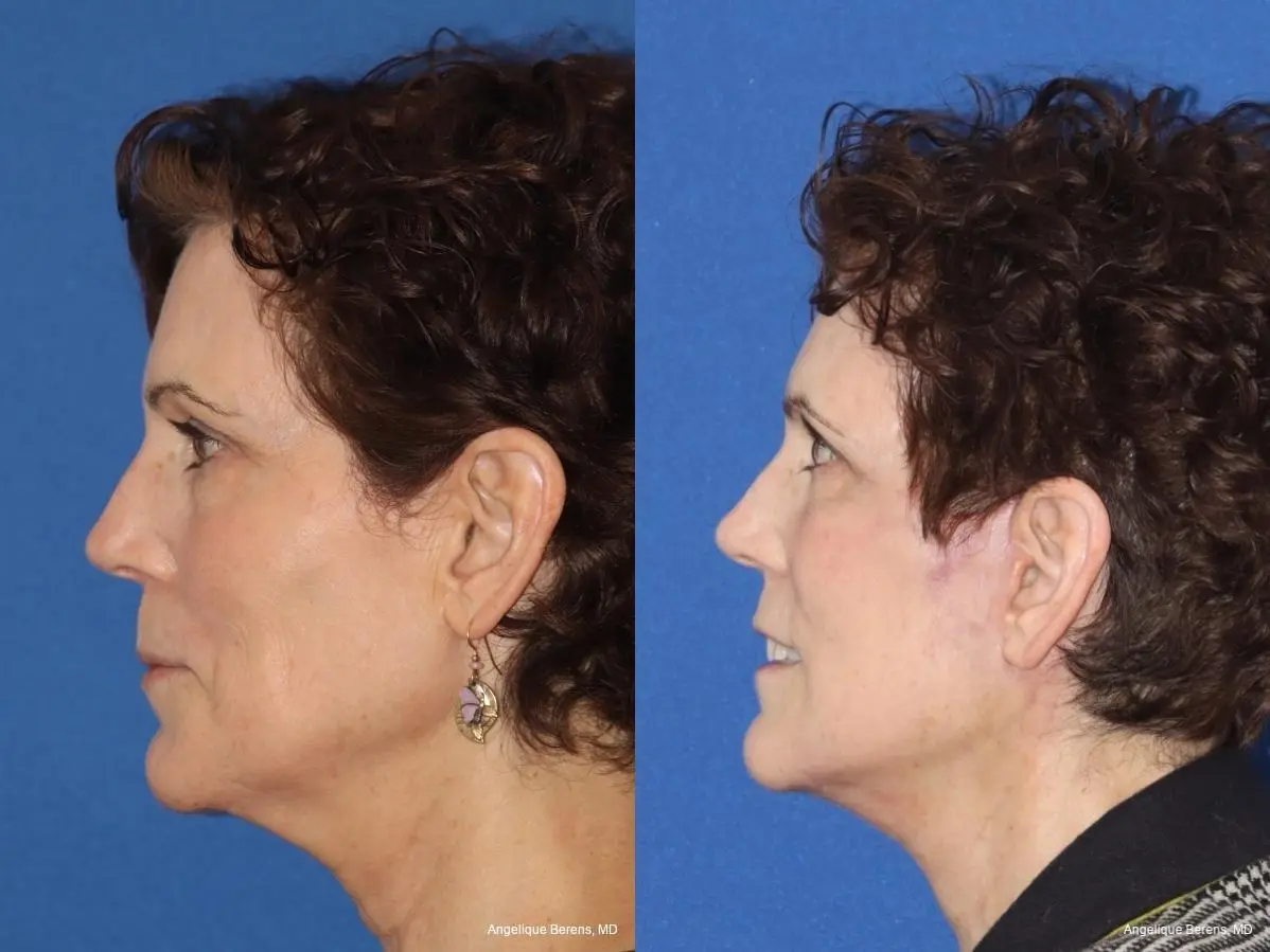 Facelift & Neck Lift: Patient 4 - Before and After  