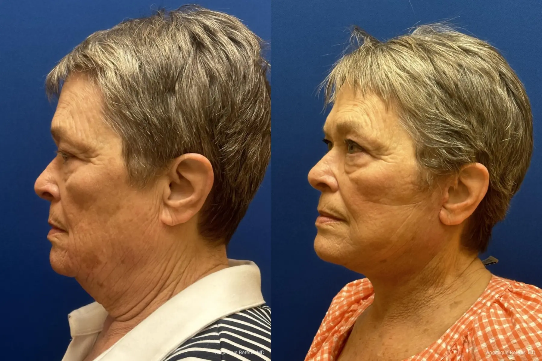 Facelift & Neck Lift: Patient 10 - Before and After  