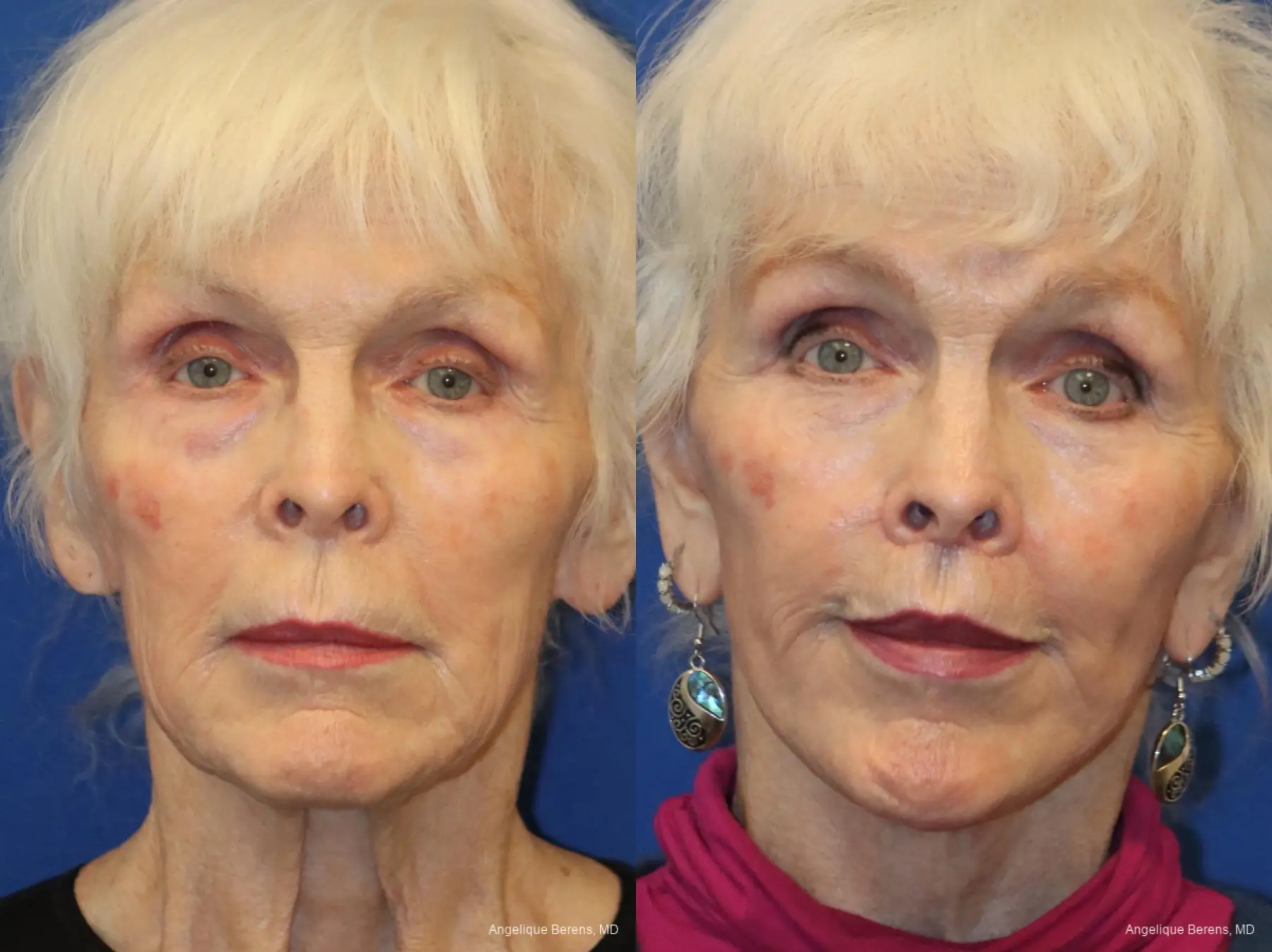 Lip Lift: Patient 3 - Before and After  