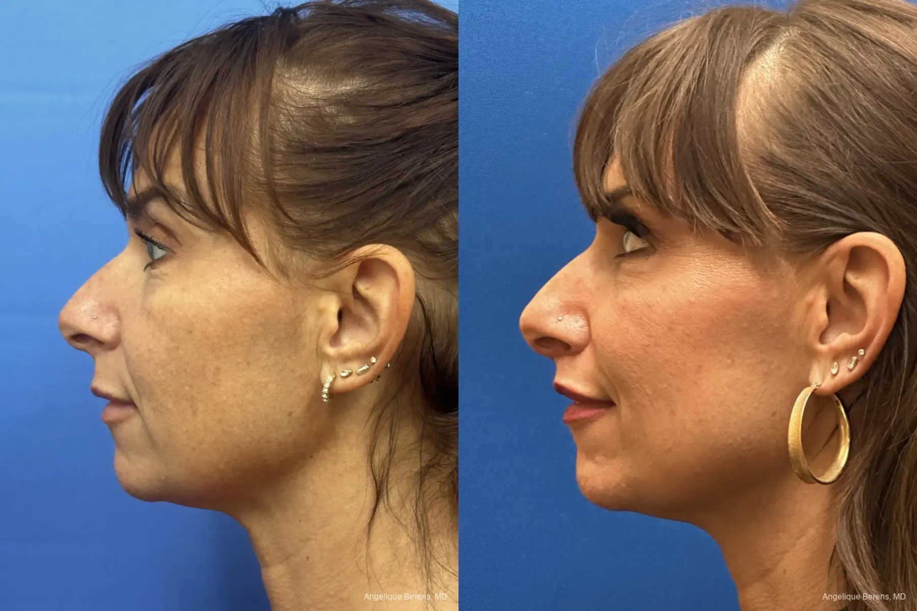 Lip Lift: Patient 2 - Before and After  