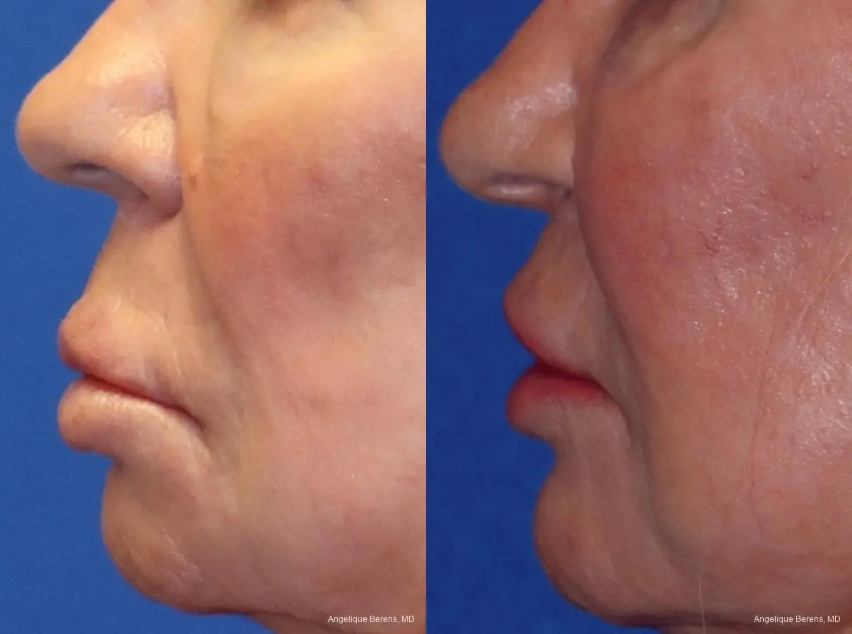 Lip Lift: Patient 1 - Before and After  