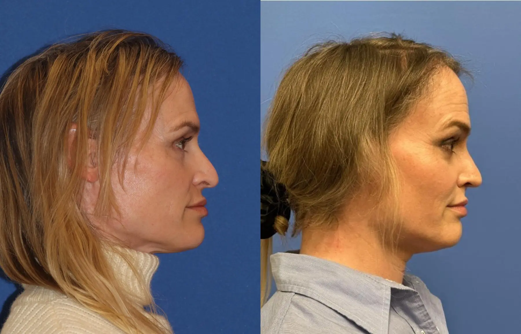 Lip Lift: Patient 3 - Before and After  