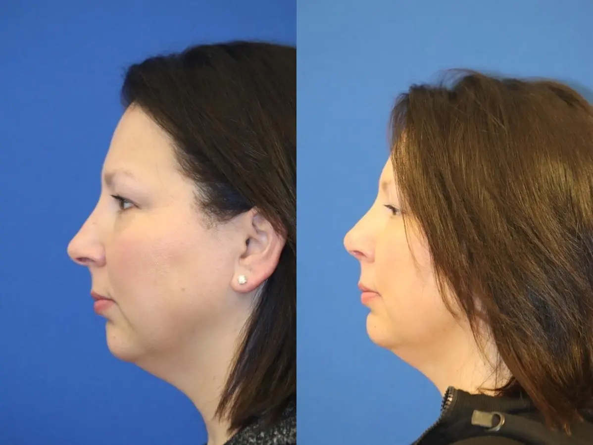 Rhinoplasty: Patient 2 - Before and After  