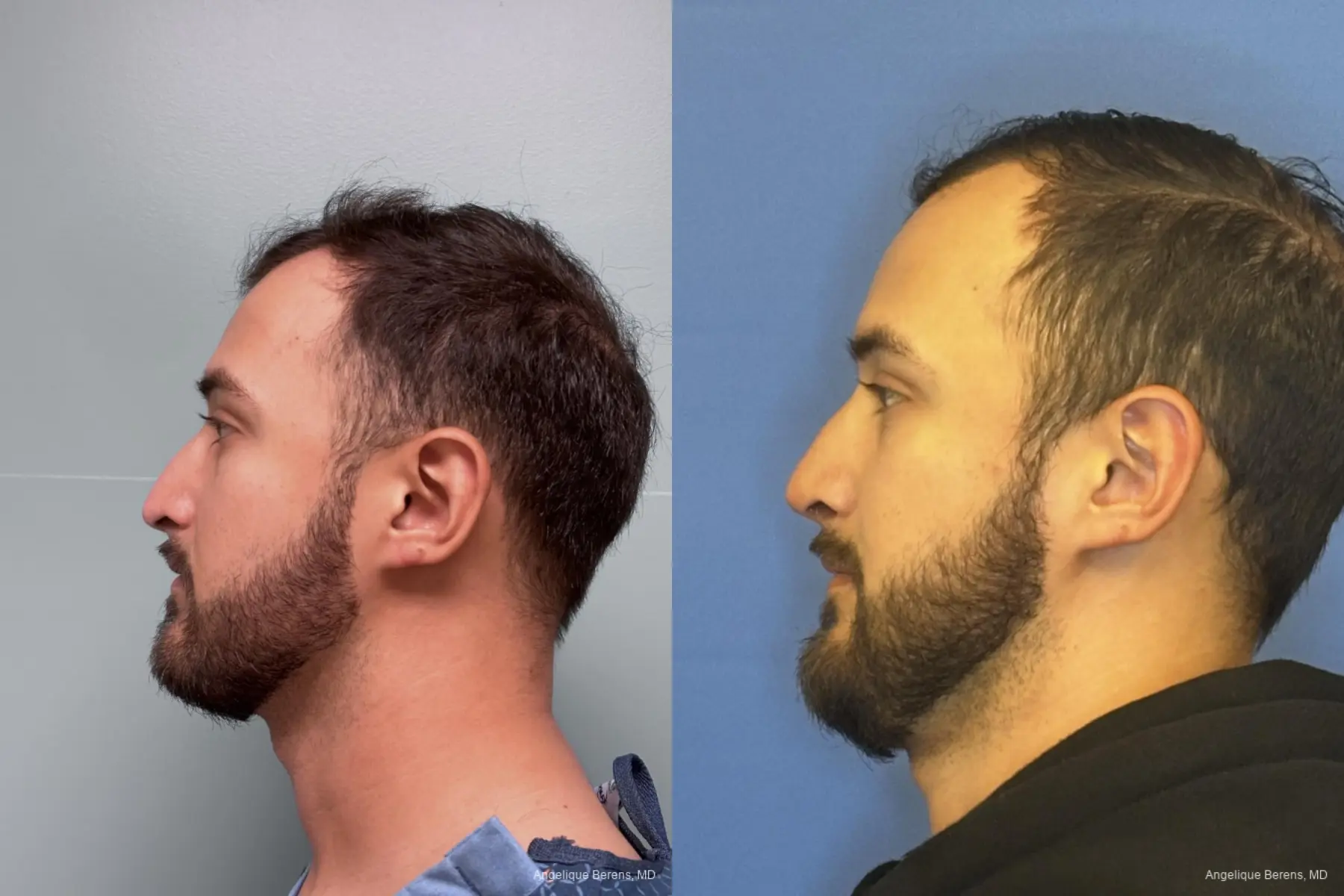 Rhinoplasty: Patient 7 - Before and After  