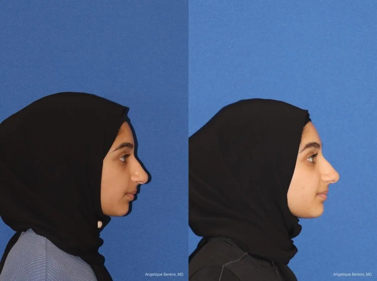 Rhinoplasty: Patient 4 - Before and After  