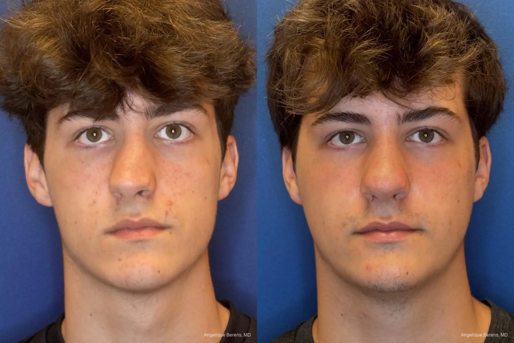Rhinoplasty: Patient 5 - Before and After  