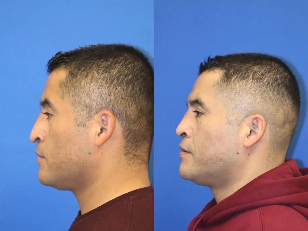 Rhinoplasty: Patient 3 - Before and After  