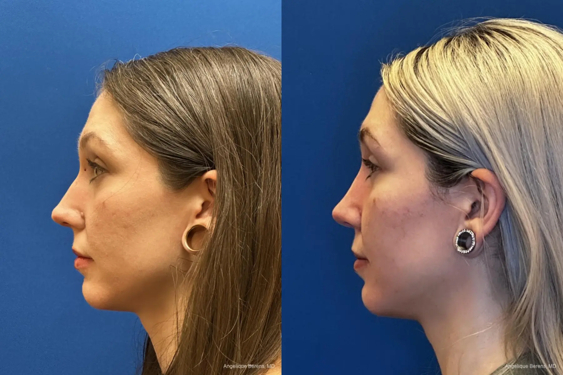 Rhinoplasty: Patient 6 - Before and After  