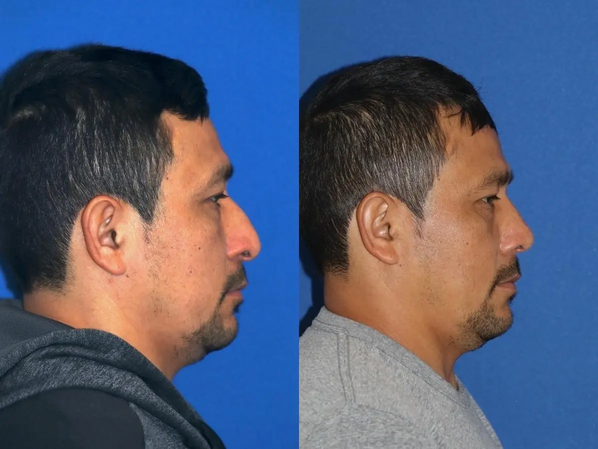 Rhinoplasty: Patient 1 - Before and After  