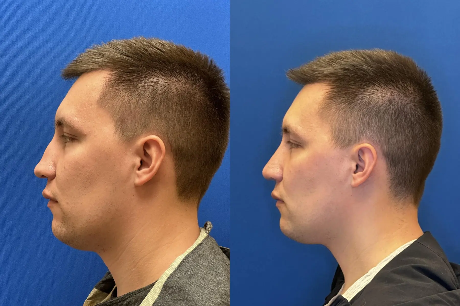 Rhinoplasty: Patient 5 - Before and After  
